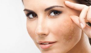 Macchie scure sul viso: come prevenirle e ridurle Bollicine Vip