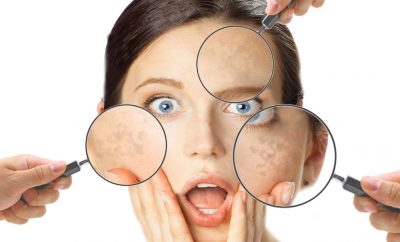 Macchie scure sul viso: come prevenirle e ridurle